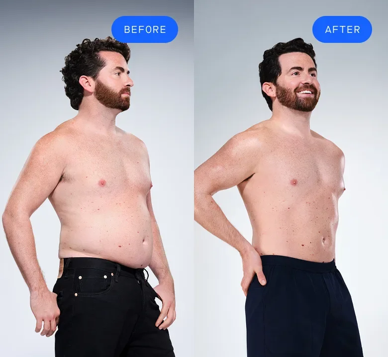 CoolSculpting male model before & after CoolSculpting
