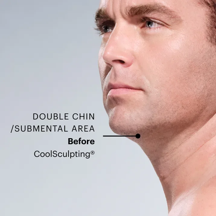 Zoomed-in image of CoolSculpting model's chin before the treatment 