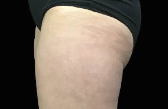 Before and after images of CoolSculpting female model's banana roll