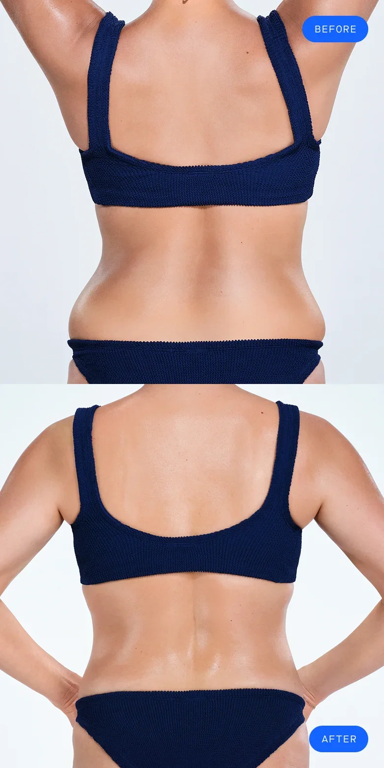 CoolSculpting before & after of model's back