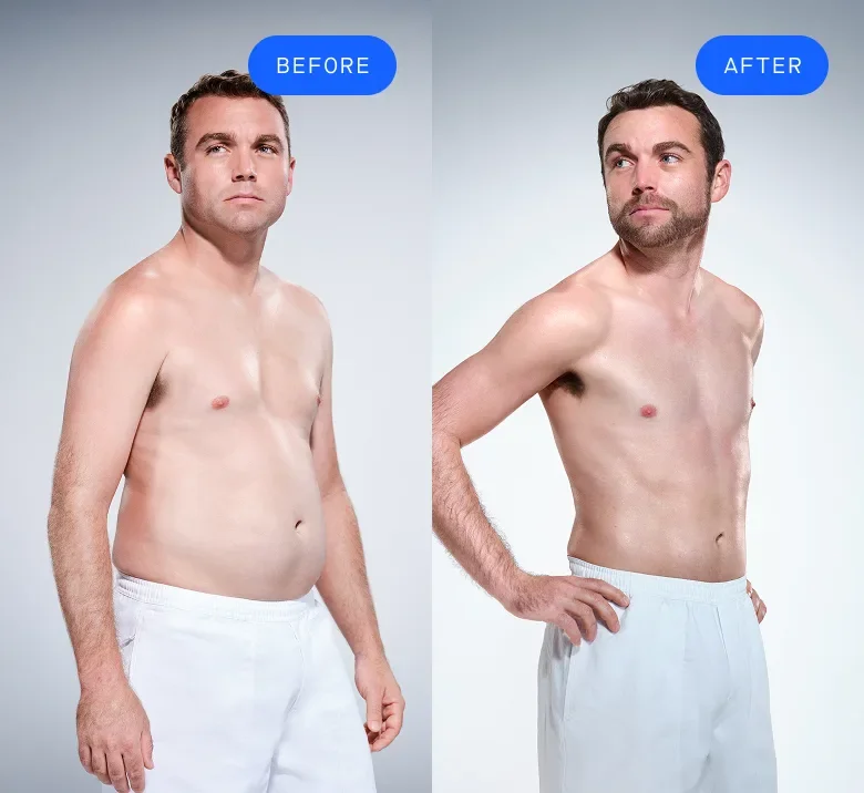 CoolSculpting male model before & after CoolSculpting