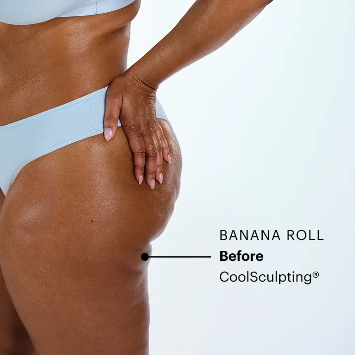 Zoomed-in image of CoolSculpting model's banana roll before the treatment 