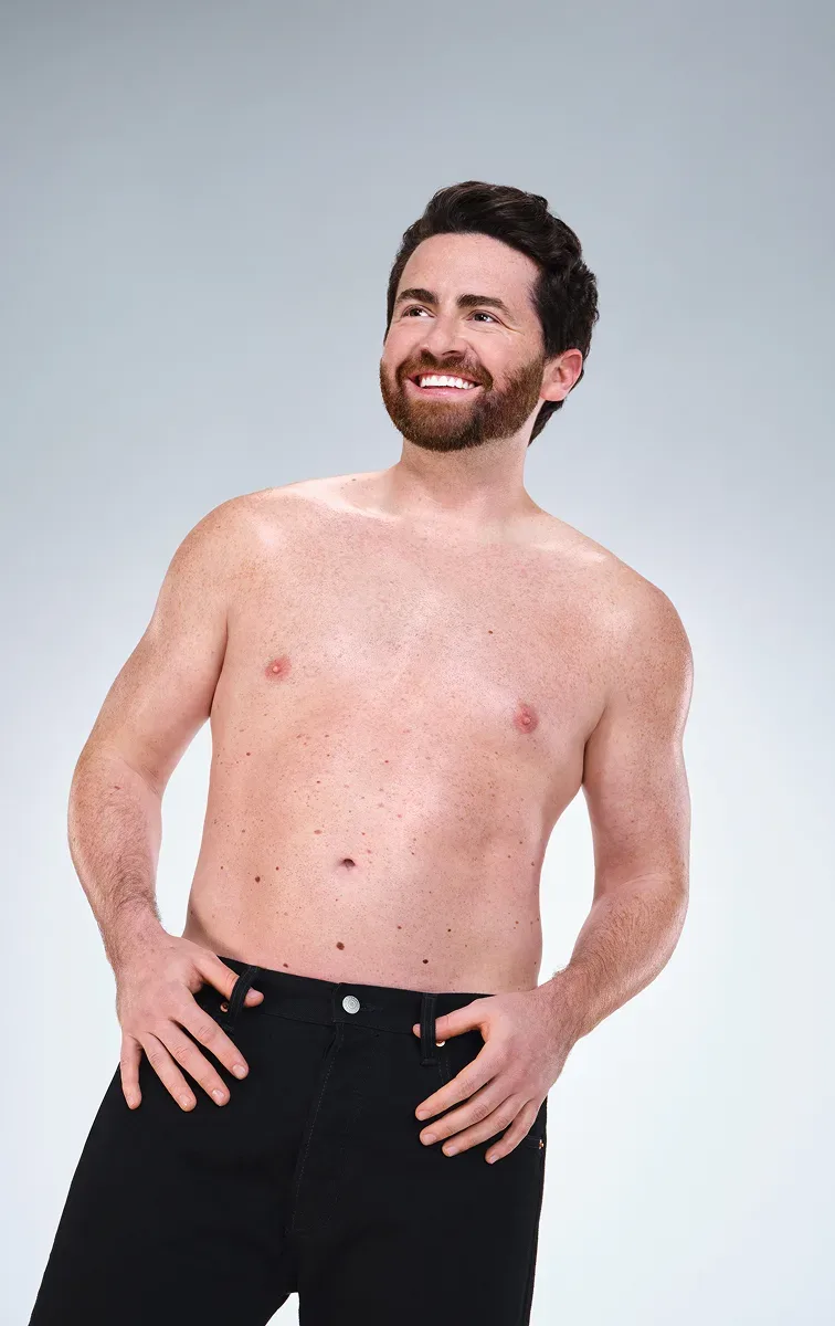 Caucasian male's CoolSculpting results