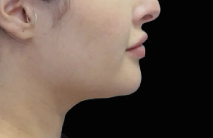 Before and after images of CoolSculpting female model's chin