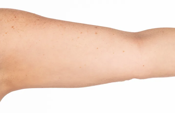 Before and after images of CoolSculpting female model's arms