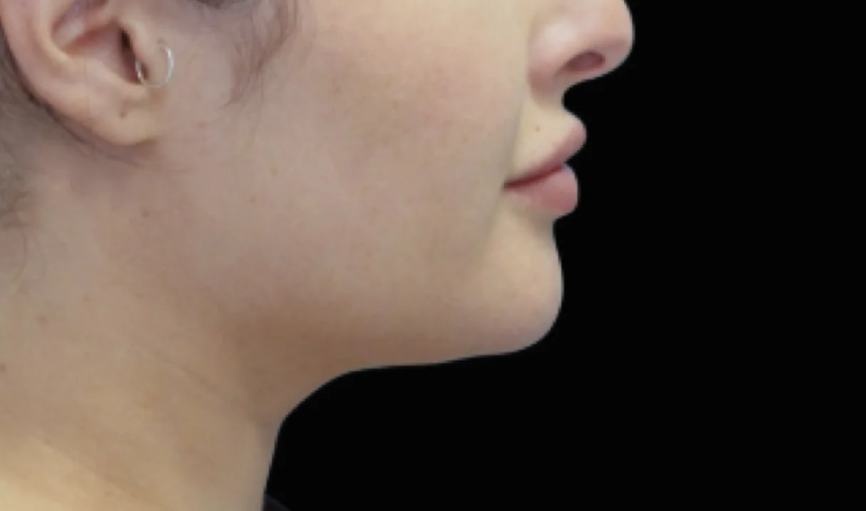 Before and after images of CoolSculpting female model's chin