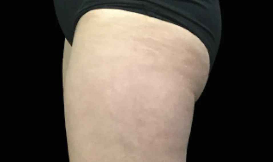 Before and after images of CoolSculpting female model's banana roll