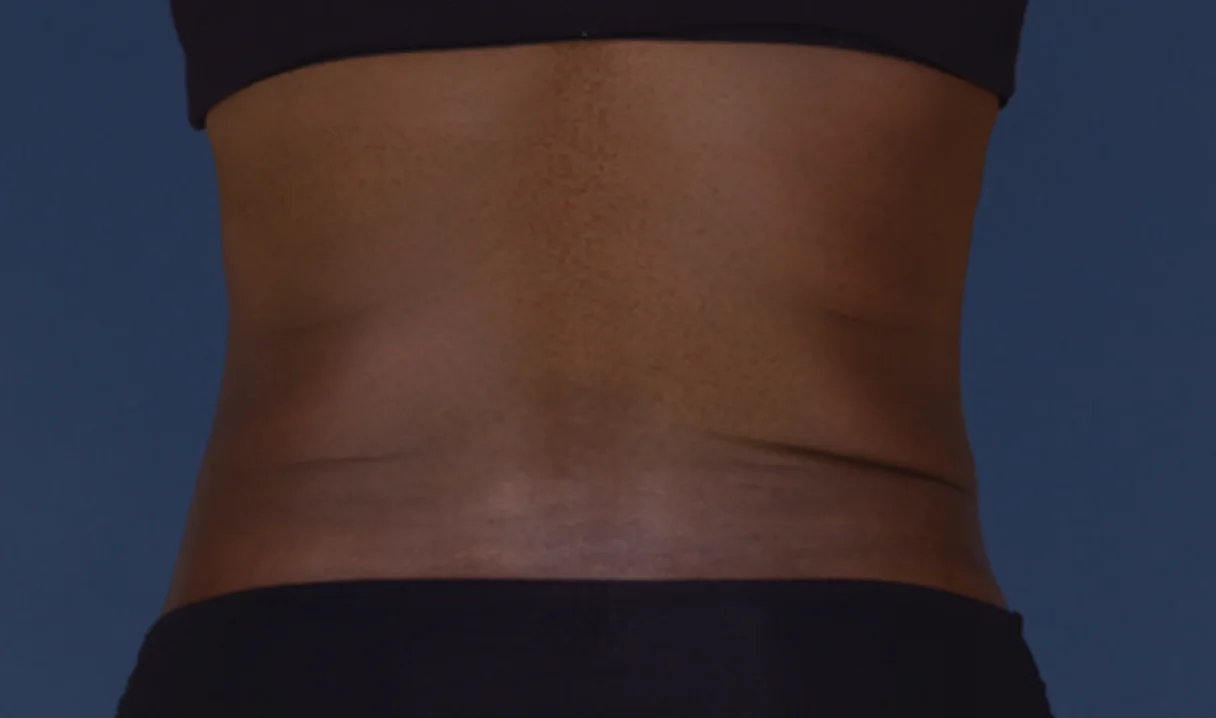 Before and after images of CoolSculpting female model's abdomen