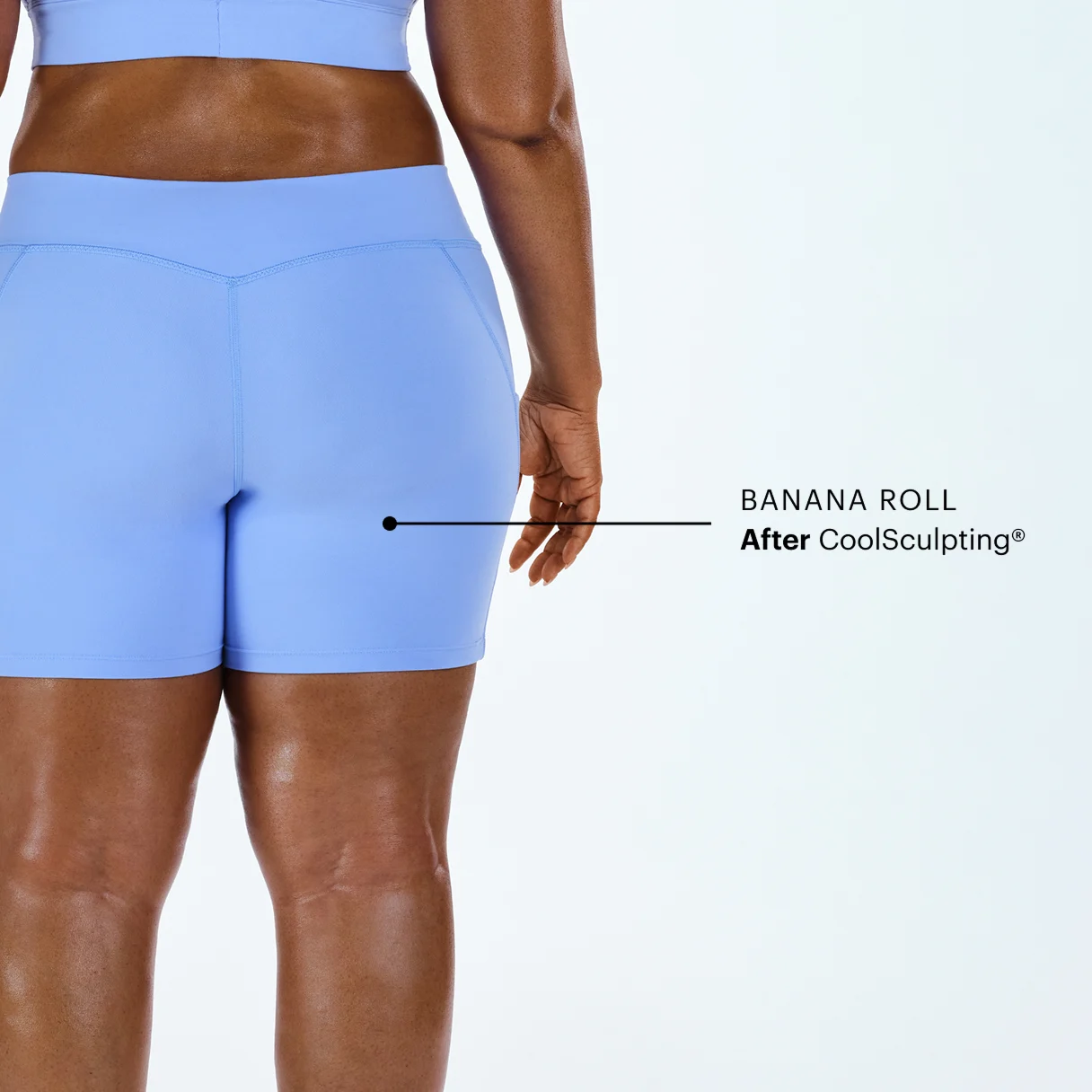 Zoomed-in image of CoolSculpting model's banana roll after the treatment 