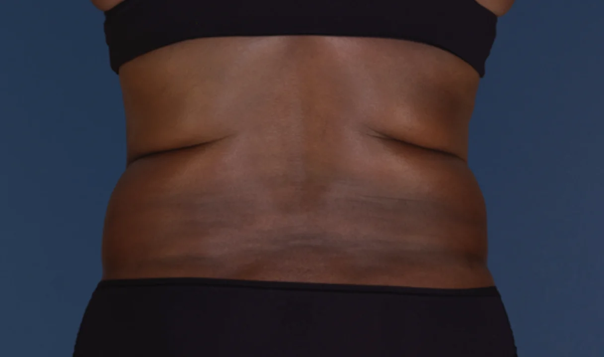 Before and after images of CoolSculpting female model's abdomen