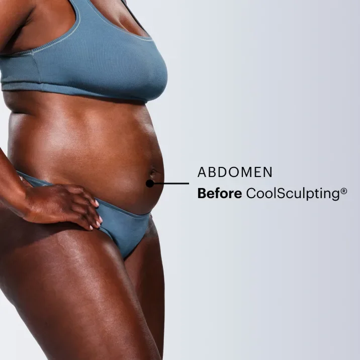 Zoomed-in image of CoolSculpting model's abdomen before the treatment