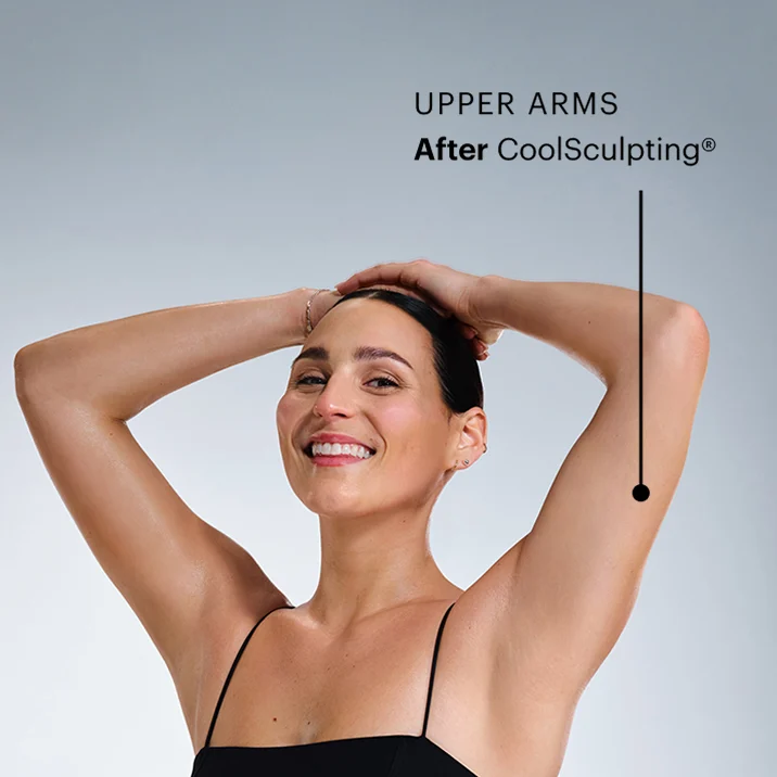 CoolSculpting model's arms after the treatment 