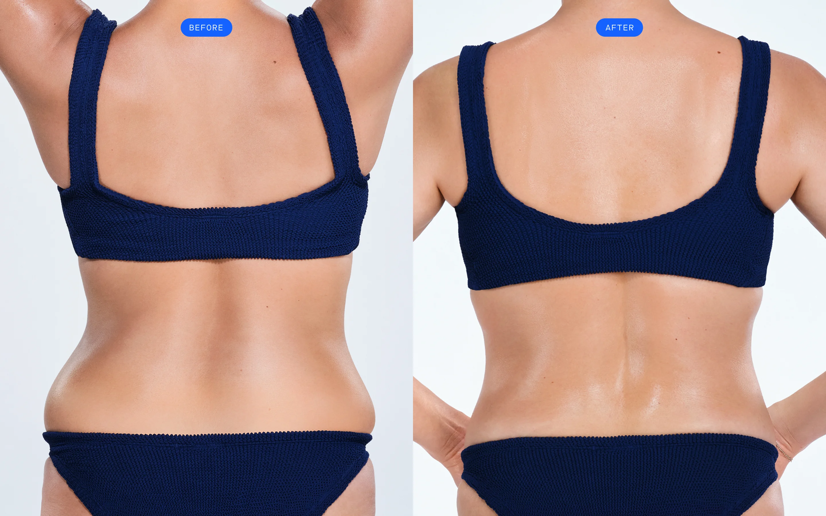 CoolSculpting before & after of model's back