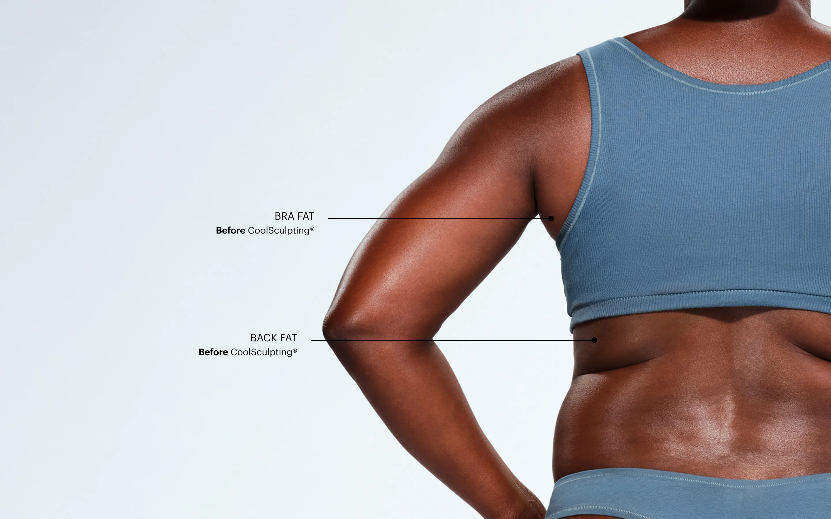 Zoomed-in image of CoolSculpting model's back fat/bra fat before the treatment 