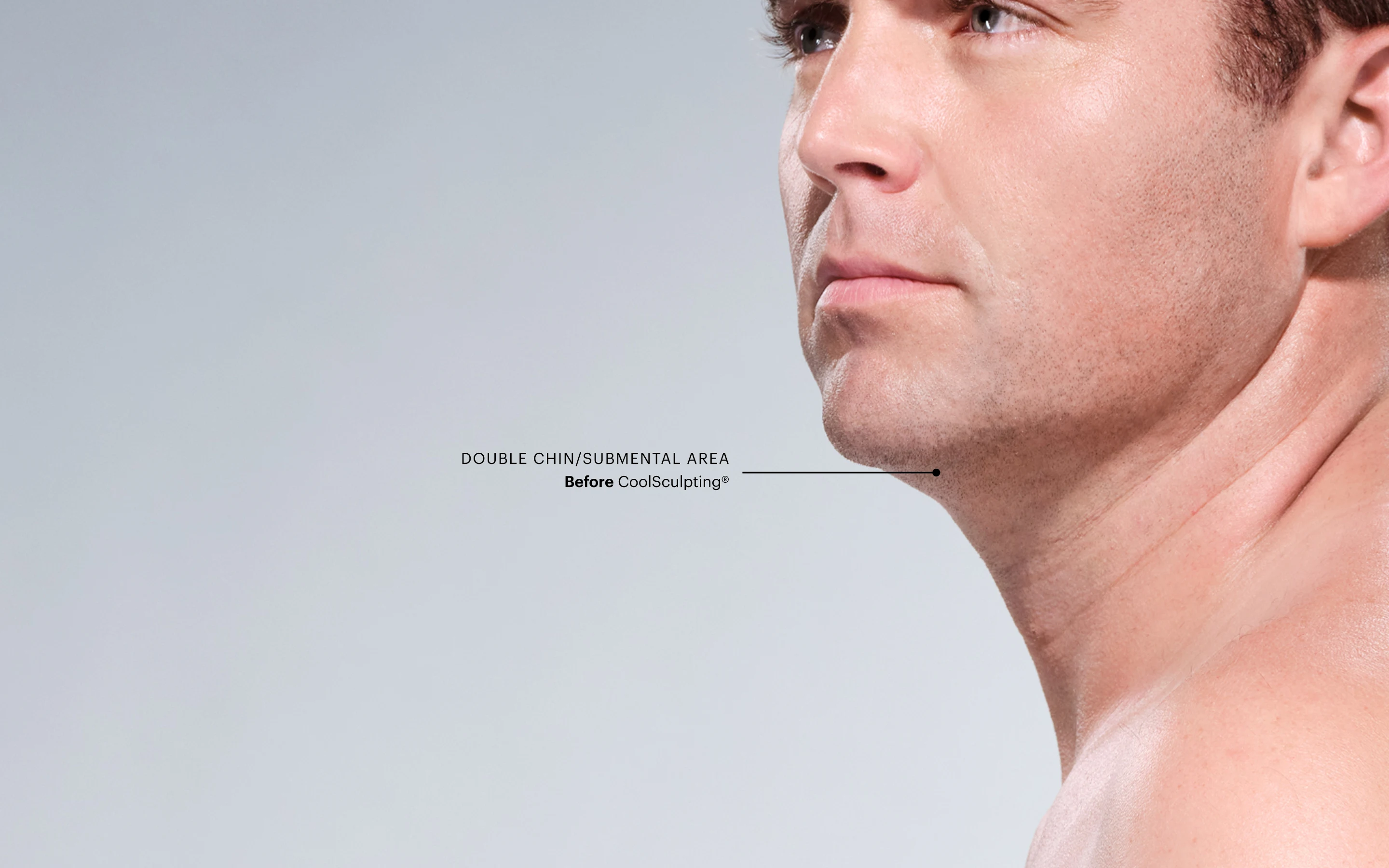 Zoomed-in image of CoolSculpting model's chin before the treatment 