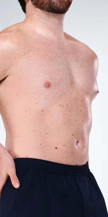 Before and after images of CoolSculpting male model's abdomen