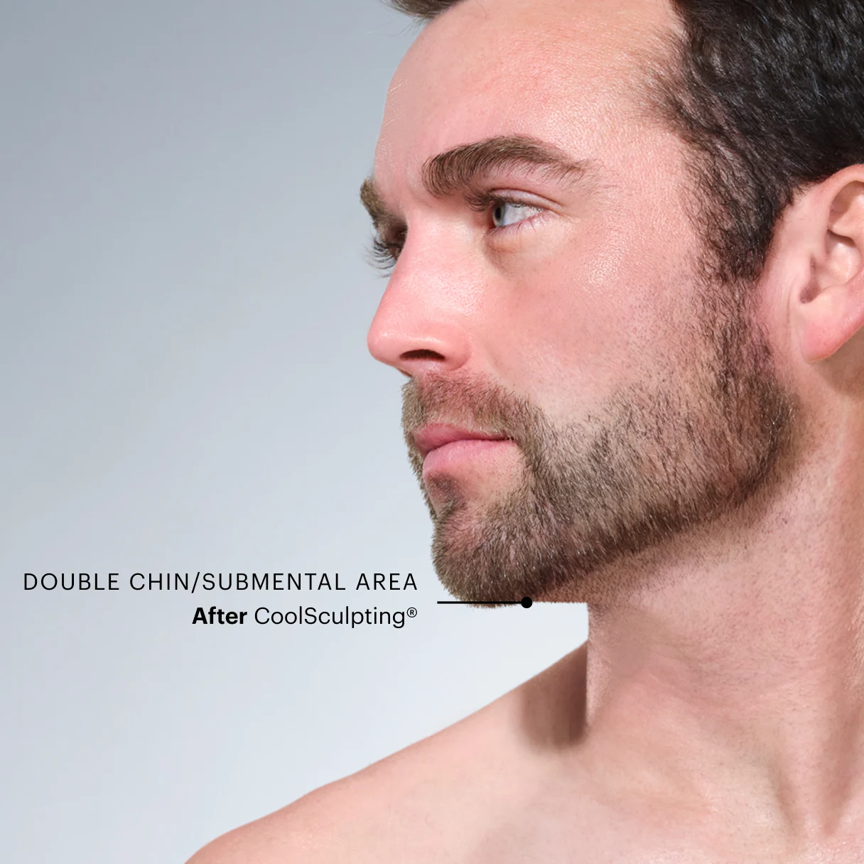 Zoomed-in image of CoolSculpting model's chin after the treatment 