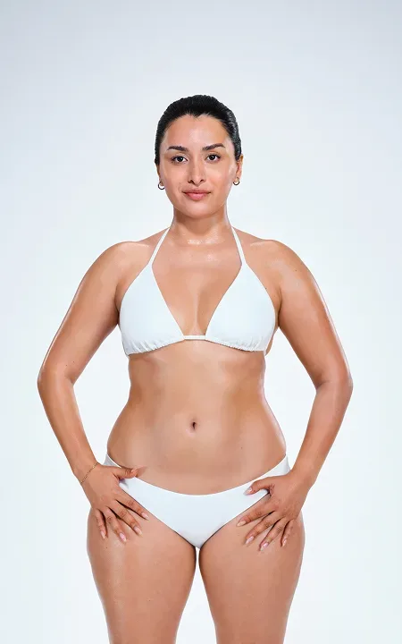 Latina female's CoolSculpting results