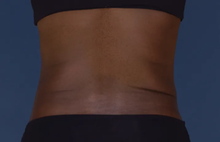 Before and after images of CoolSculpting female model's abdomen