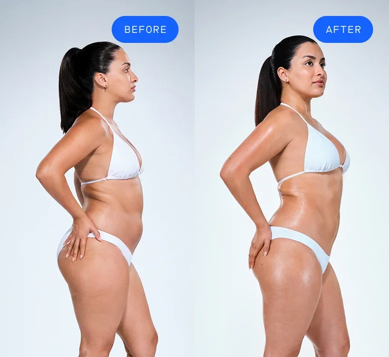 CoolSculpting female model before & after CoolSculpting
