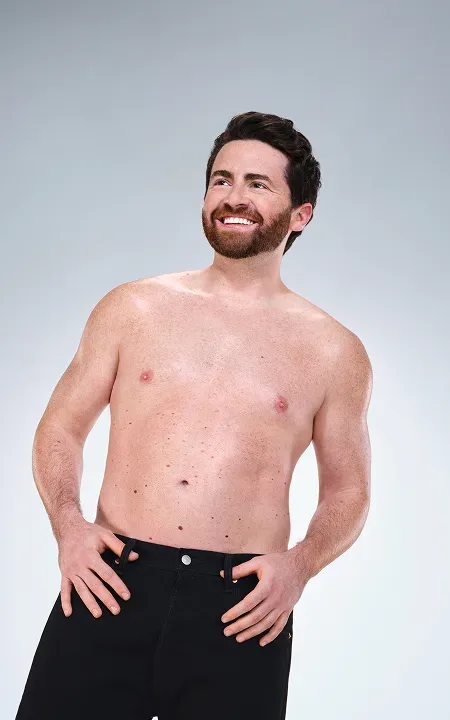 Caucasian male's CoolSculpting results