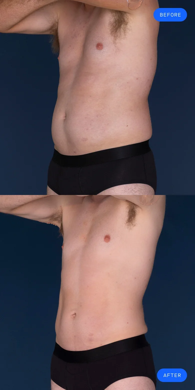 CoolSculpting before & after of model's abdomen