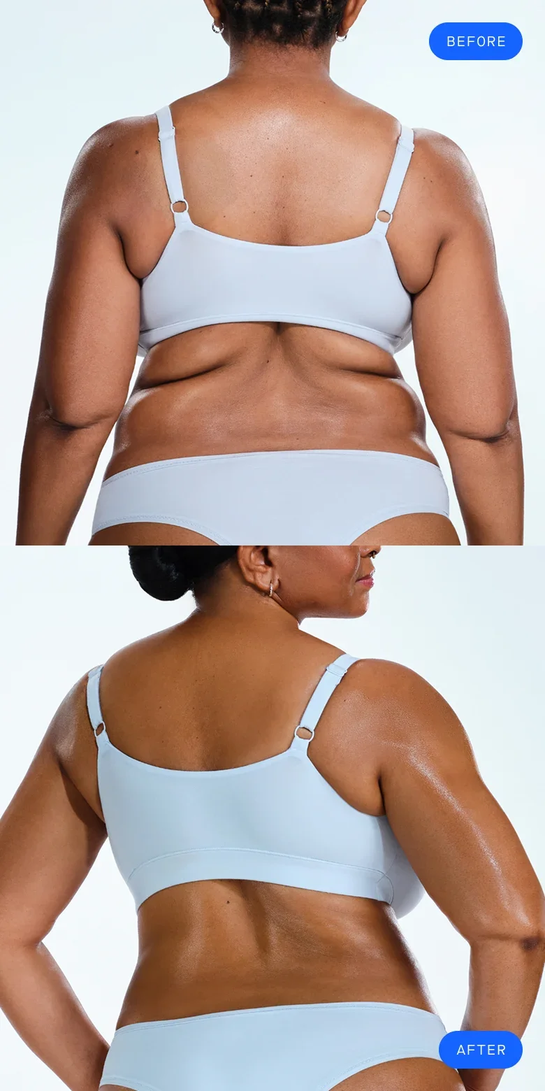 CoolSculpting before & after of model's back