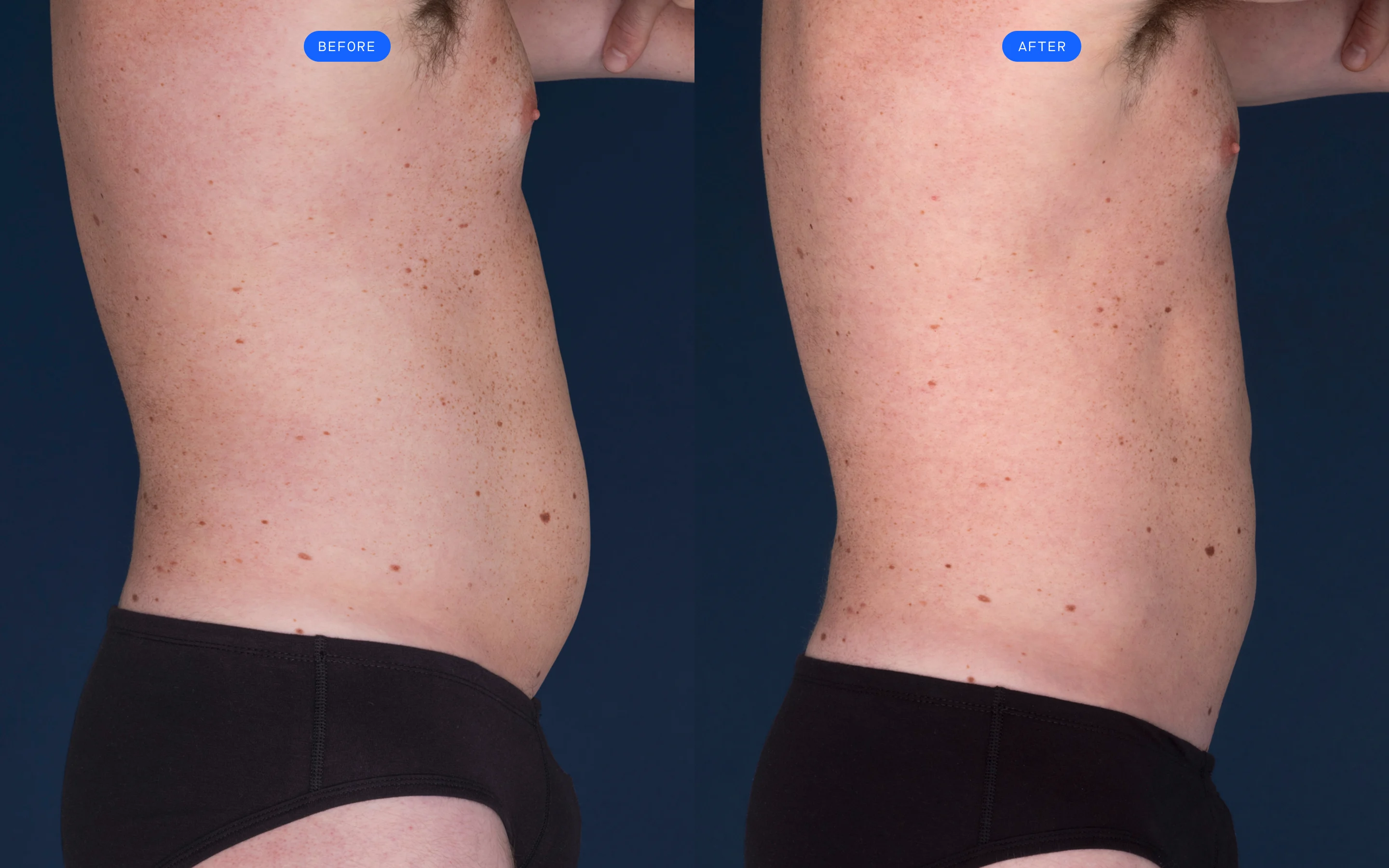 CoolSculpting before & after of model's abdomen