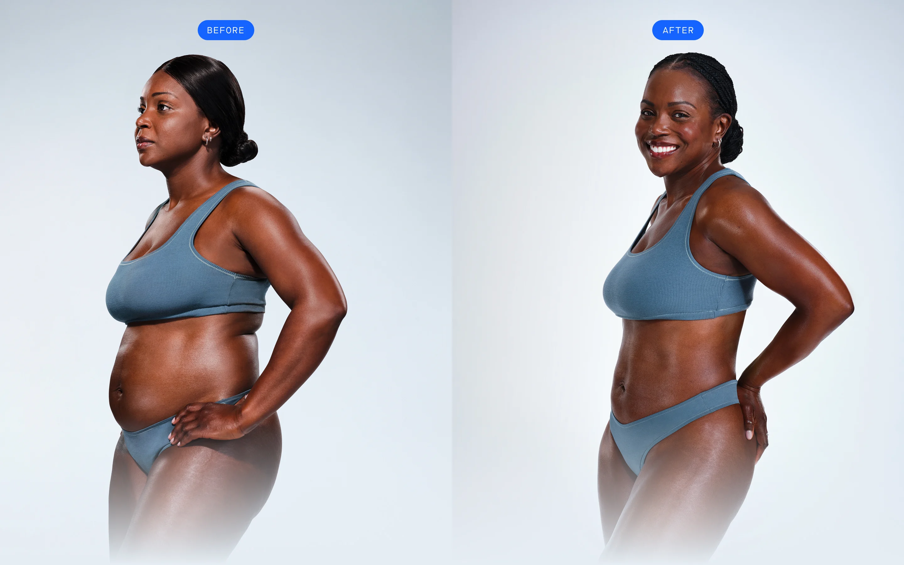 CoolSculpting female model before & after CoolSculpting