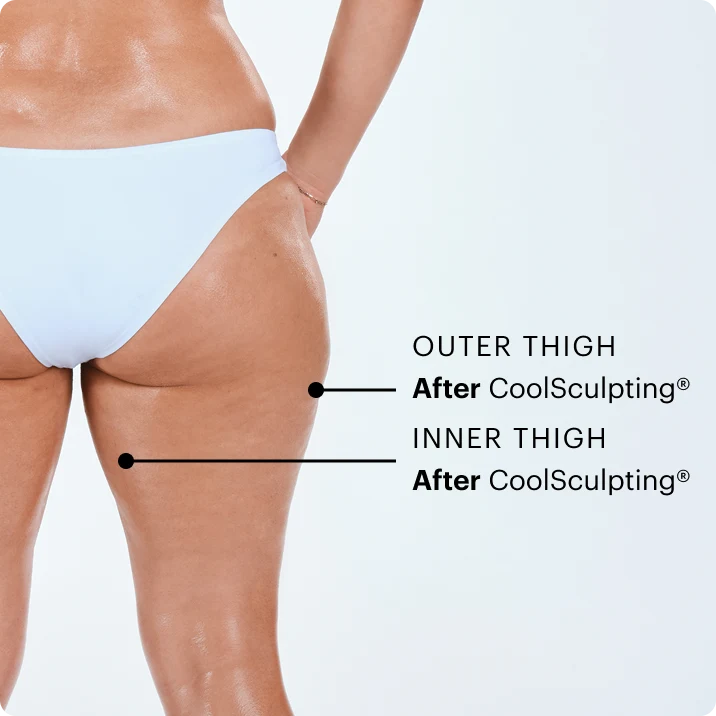 Zoomed-in image of CoolSculpting model's thighs after the treatment 