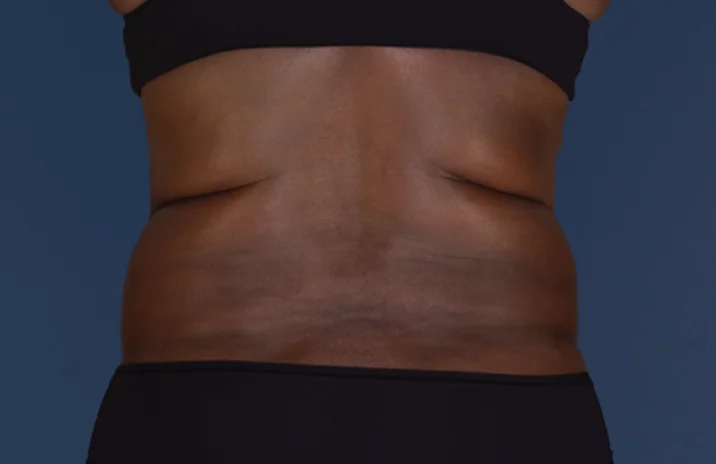 Before and after images of CoolSculpting female model's abdomen