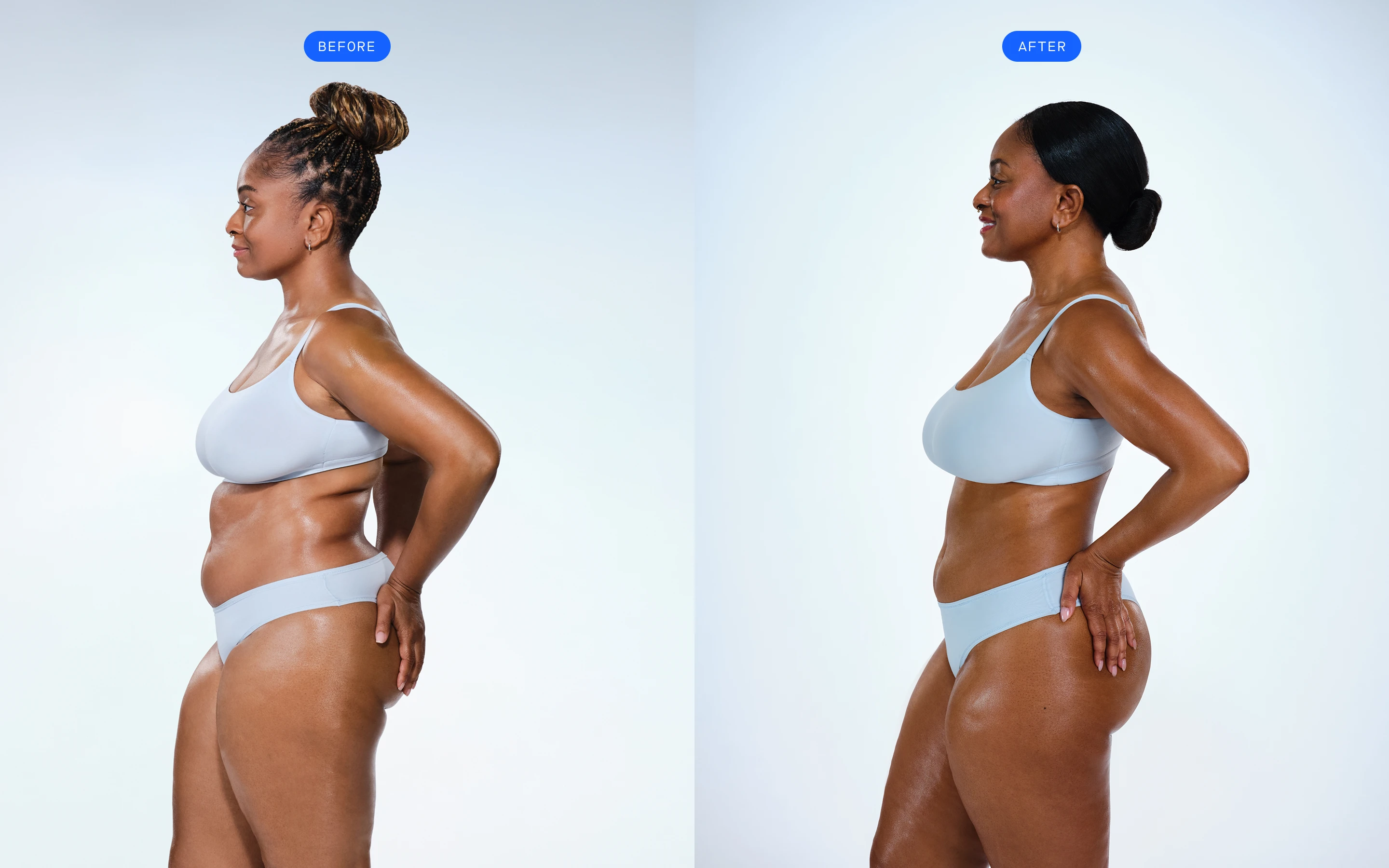 CoolSculpting female model before & after CoolSculpting