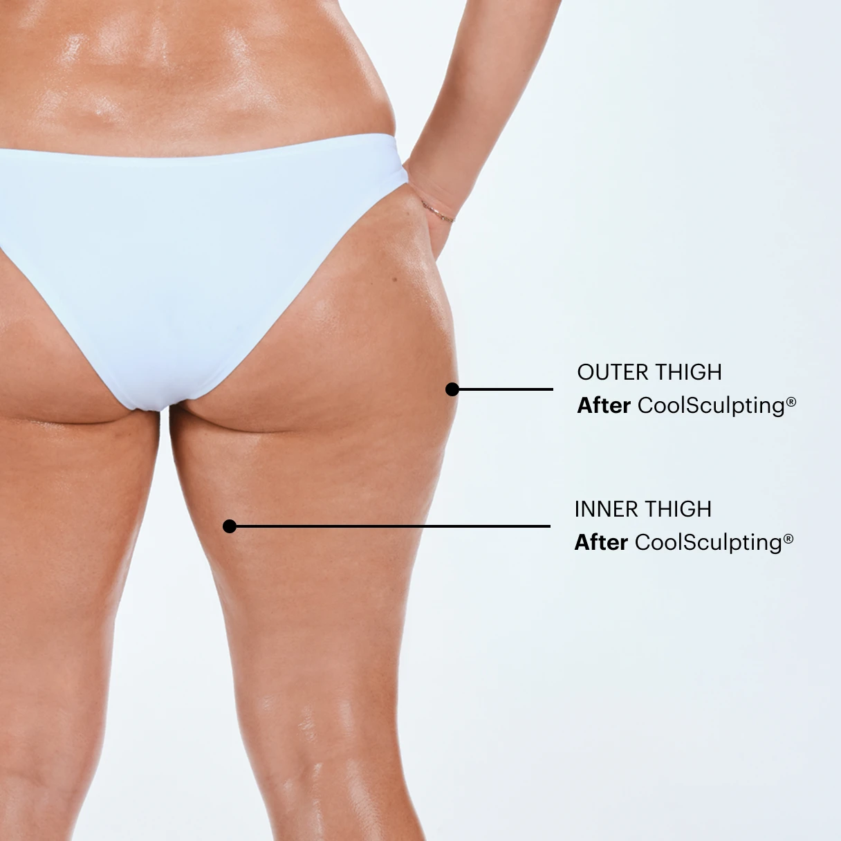 Zoomed-in image of CoolSculpting model's thighs after the treatment 