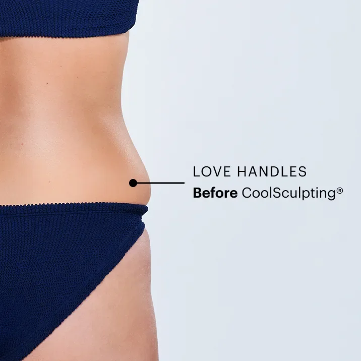 Zoomed-in image of CoolSculpting model's love handles before the treatment
