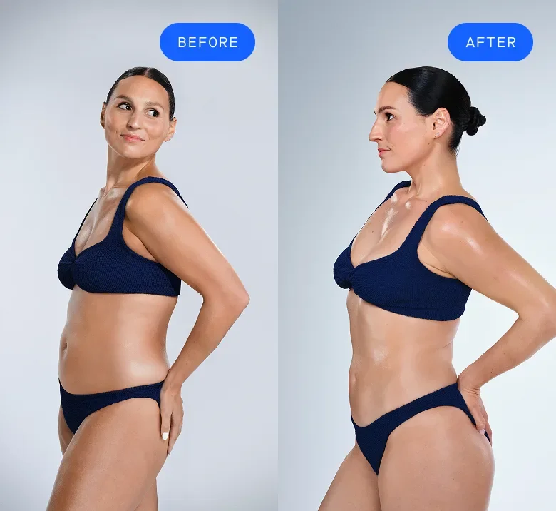 CoolSculpting female model before & after CoolSculpting