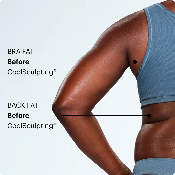Zoomed-in image of CoolSculpting model's back fat/bra fat before the treatment 