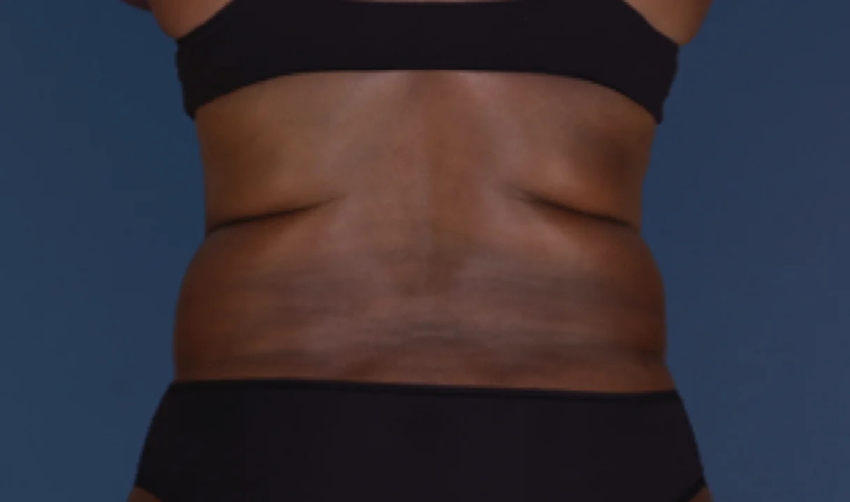 Before and after images of CoolSculpting female model's back fat/bra fat