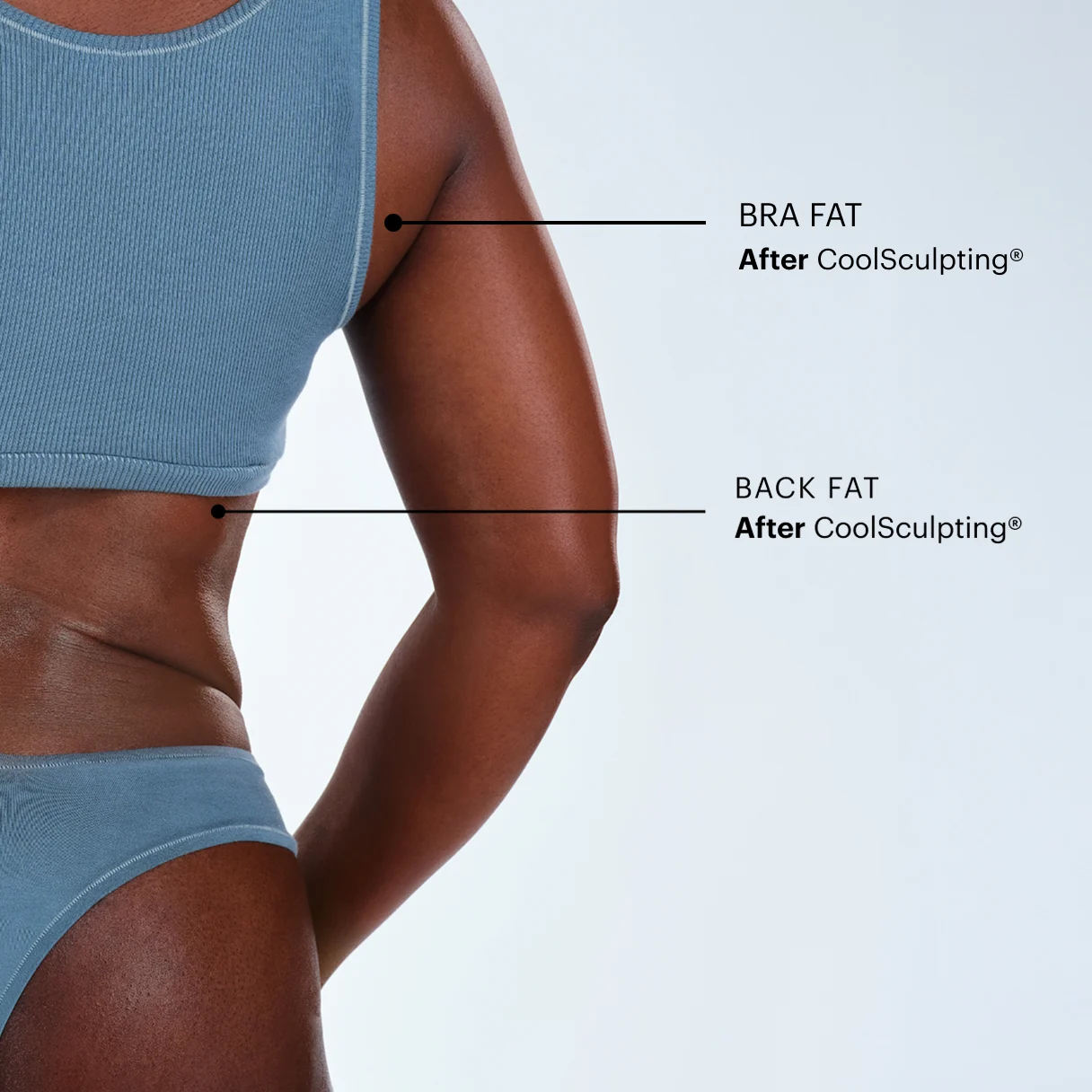 Zoomed-in image of CoolSculpting model's back fat/bra fat before the treatment 