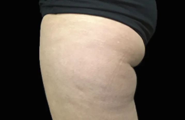 Before and after images of CoolSculpting female model's banana roll