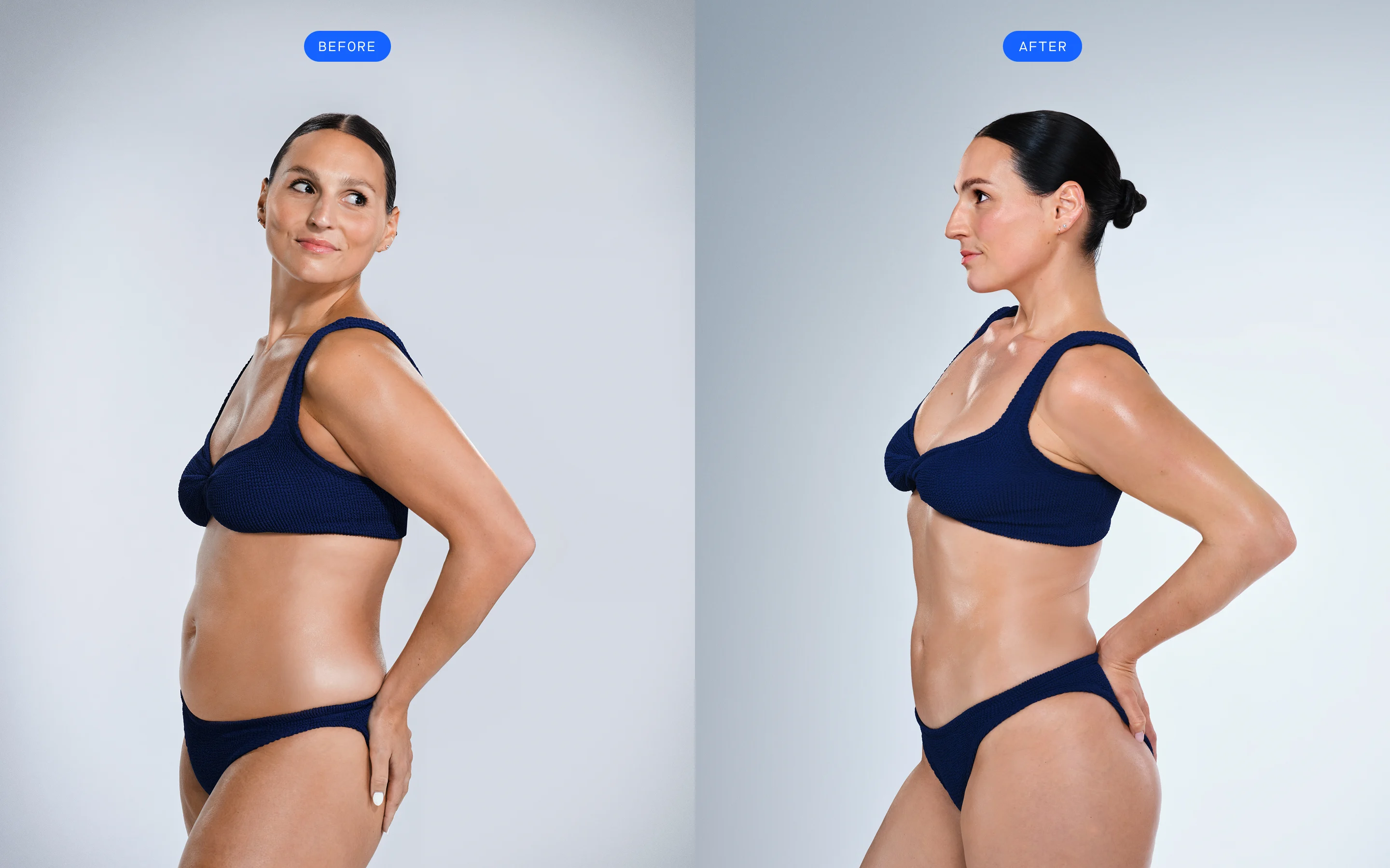 CoolSculpting female model before & after CoolSculpting