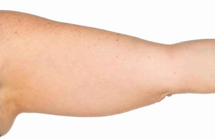 Before and after images of CoolSculpting female model's arms