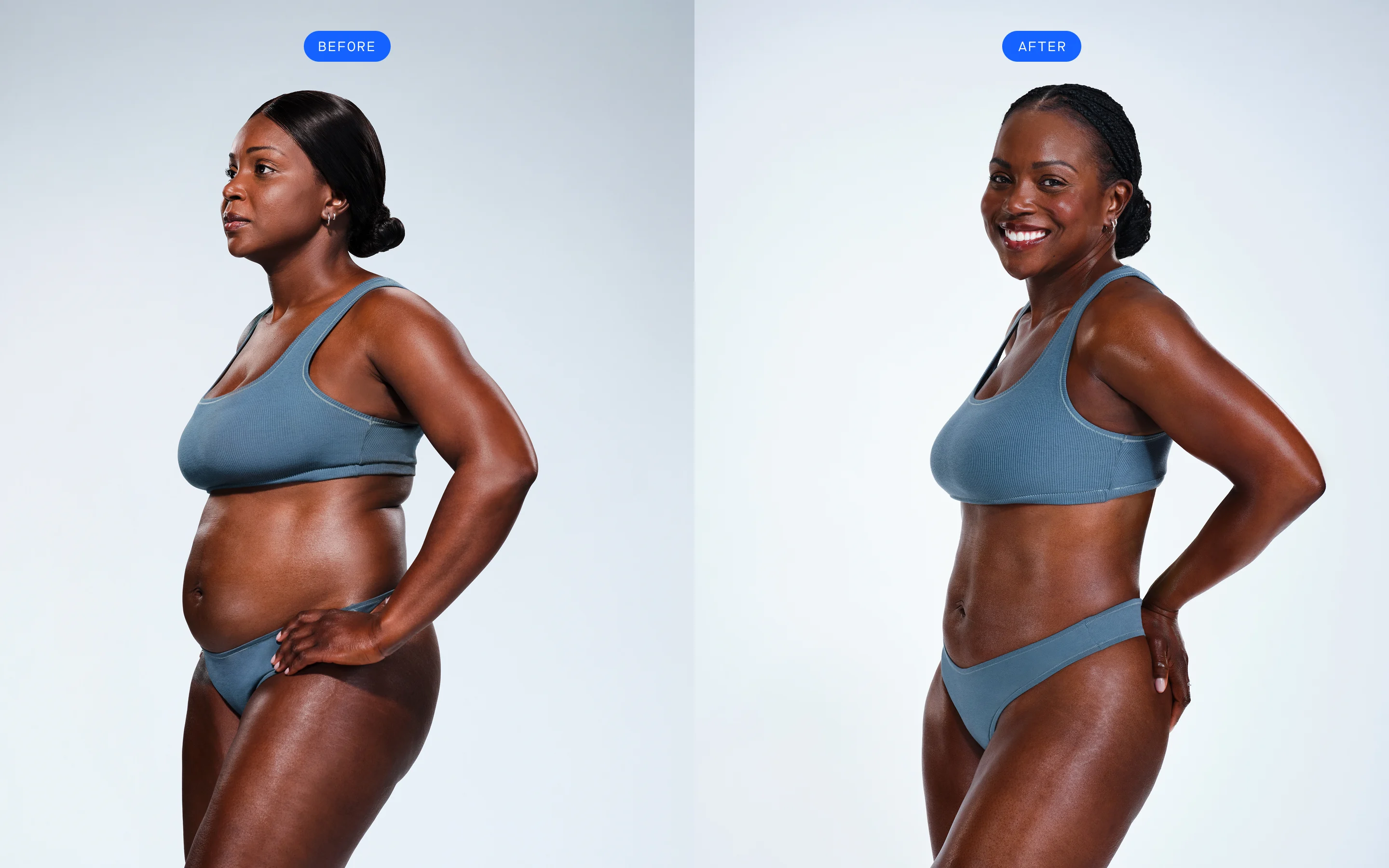 CoolSculpting female model before & after CoolSculpting