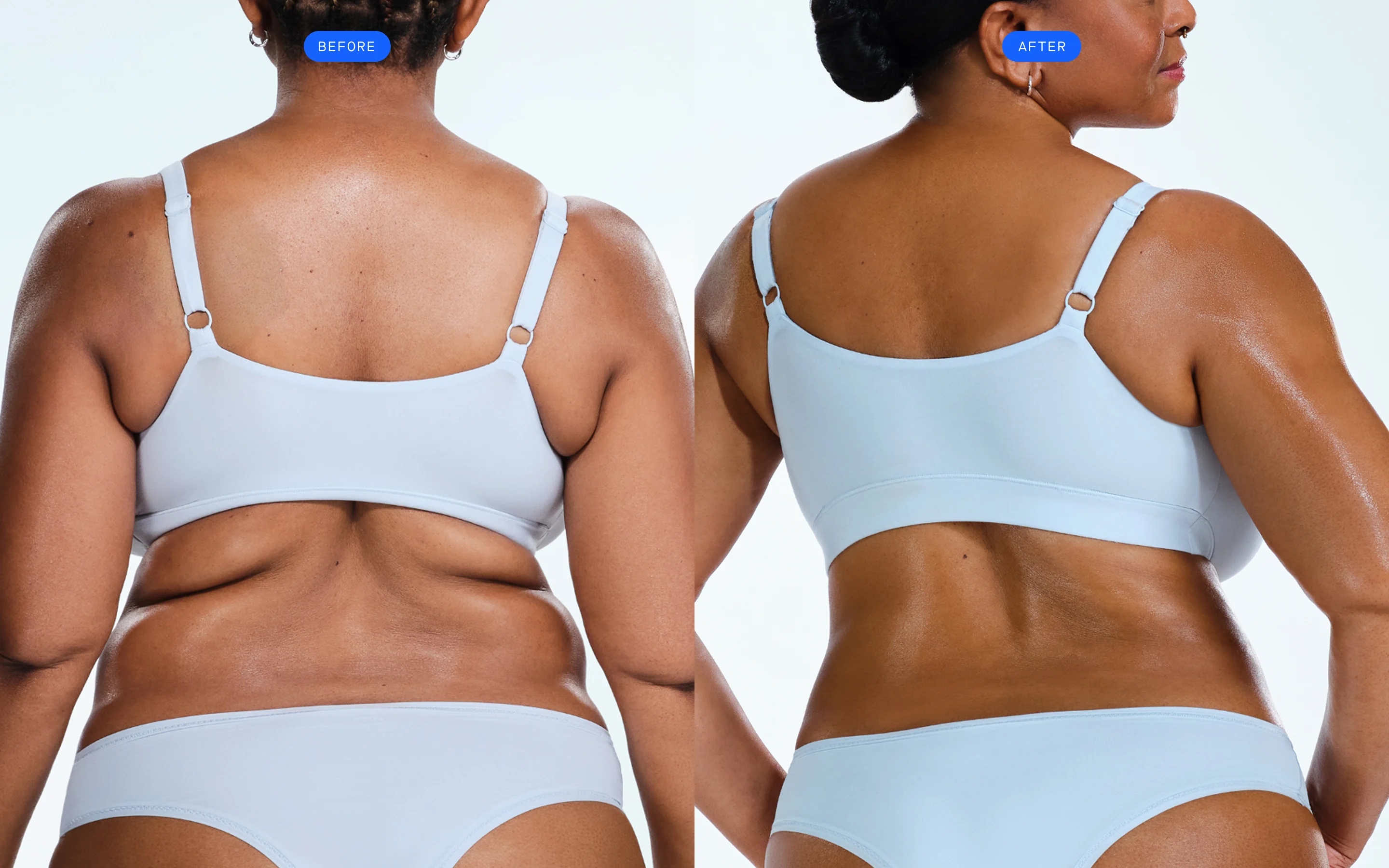 CoolSculpting before & after of model's back