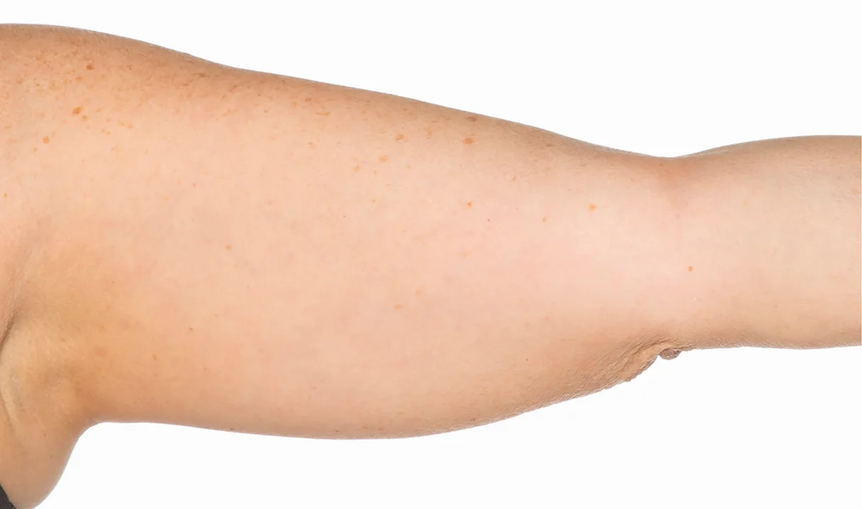 Before and after images of CoolSculpting female model's arms