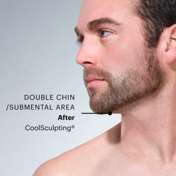 Zoomed-in image of CoolSculpting model's chin after the treatment 