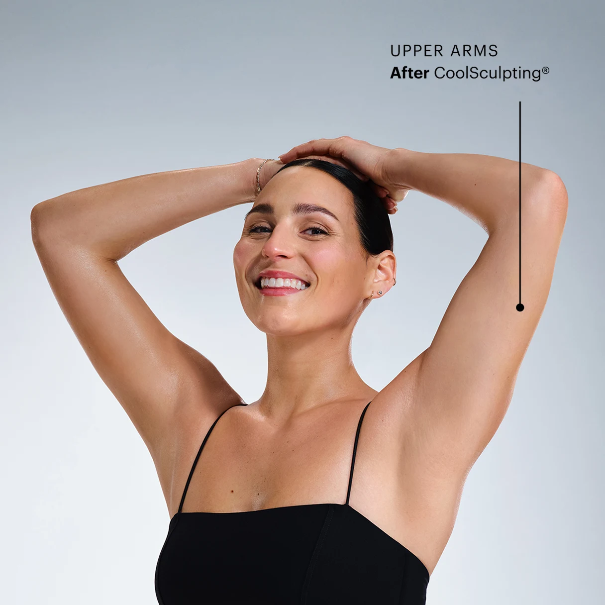 CoolSculpting model's arms after the treatment 