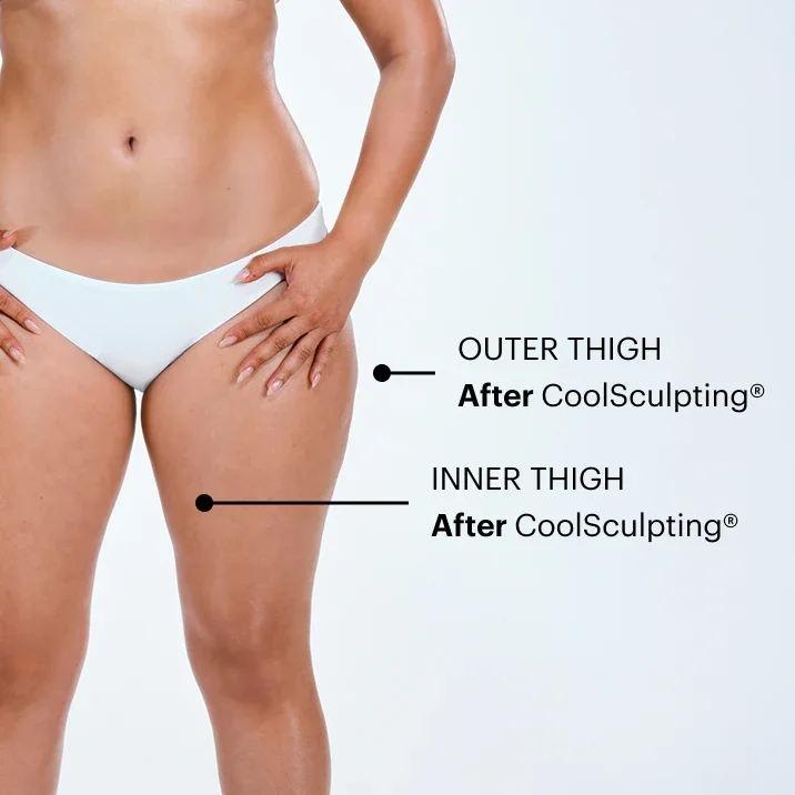 Zoomed-in image of CoolSculpting model's thighs before the treatment 