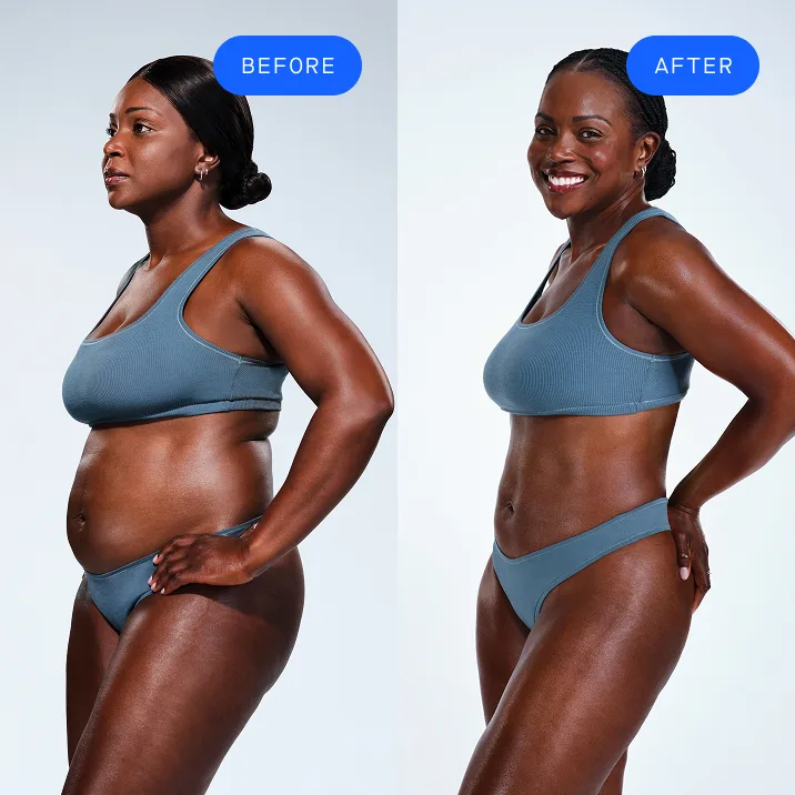 CoolSculpting female model before & after CoolSculpting