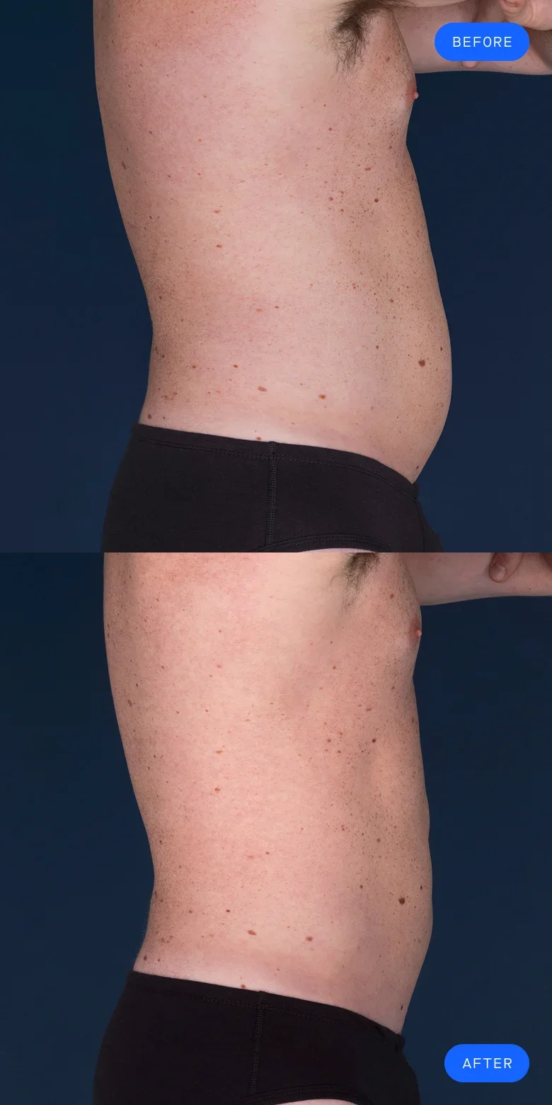 CoolSculpting before & after of model's abdomen