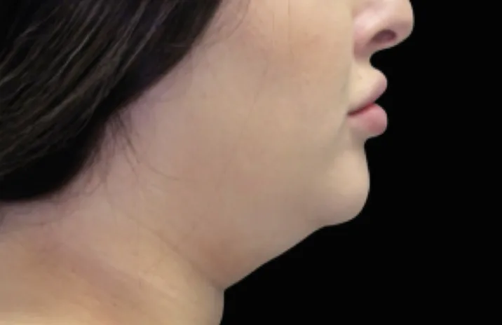 Before and after images of CoolSculpting female model's chin